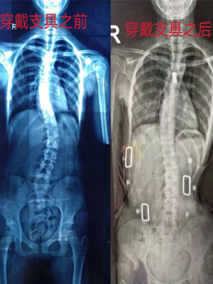 特發性脊柱側彎患者穿戴矯形器