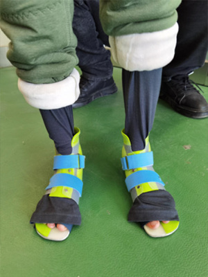 外翻平足患者穿戴DAFO动态踝足矫形器