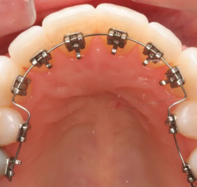 牙科—MIM自锁托槽